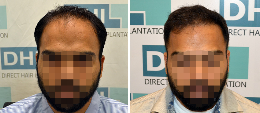 DHI before & after hair transplant results